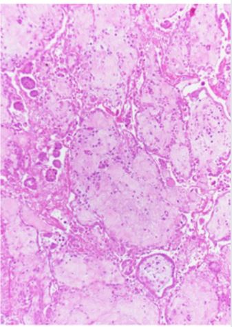 UMiamiPathology's tweet photo. Pleural biopsy from elderly male. What’s your diagnosis? #PathChallenge #UMiamiPath https://t.co/f0mONCbXvn