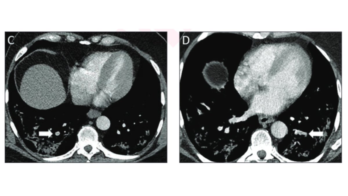 New @AJR_Radiology Accepted Manuscript: 'In Situ Pulmonary Arterial Thrombosis—Literature Review and Clinical Significance of a Distinct Entity' By Drs Baranga, @drswaite, & team @SUNYRadiology ajronline.org/doi/abs/10.221…