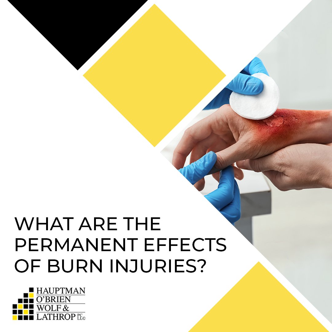 Burn victims often experience severe pain and psychological trauma, leaving them with substantial financial burdens. Other common long-term effects include burn scars, skin discoloration, nerve damage, and more. Learn more: bit.ly/3YQO7y5

#BurnInjury #PersonalInjuryLaw