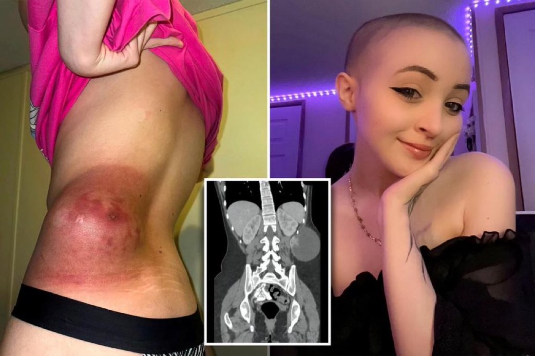 A woman makes $80,000 selling nudes on OnlyFans to pay for cancer treatment. Wow stop judging people 😭😭😭
