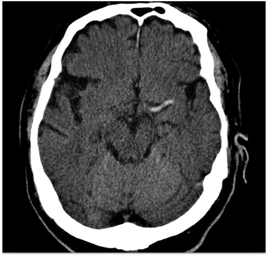 BasicNeurosurge's tweet image. Daily #Neurosurgery Quiz Question 425: 

What radiographic sign is seen in the image below? 

Comment with your answer!
Source: Andrew Dixon @Radiopaedia