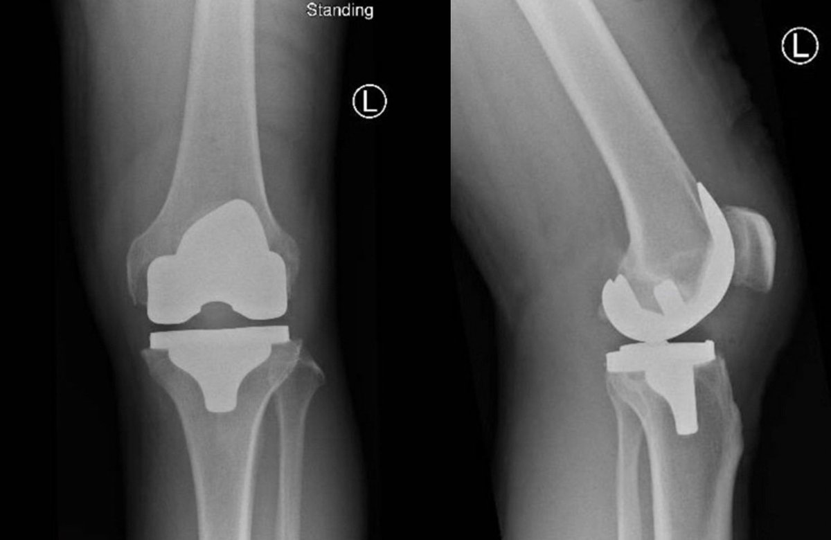 9 days post knee replacement. A new life of cycling on a turbo trainer in the garage, walking very slowly on a crutch and eating lots of fruit which I keep gratefully receiving. Rewarded by a new personal best of a 110 degree knee flexion this morning #tkr