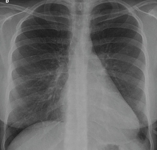 A 25-year-old presented with dyspnea and chest pain for over two months

Diagnosis?