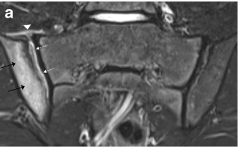 PedRadJournal's tweet photo. Now online! 

MRI in pediatric sacroiliitis, what radiologists should know

https://t.co/jyr4M2PHUQ

#MSK #radiology #Pediatrics #arthritis

STIR semicoronal MRI showing right sided active sacroiliitis https://t.co/9wL6r6MyYU