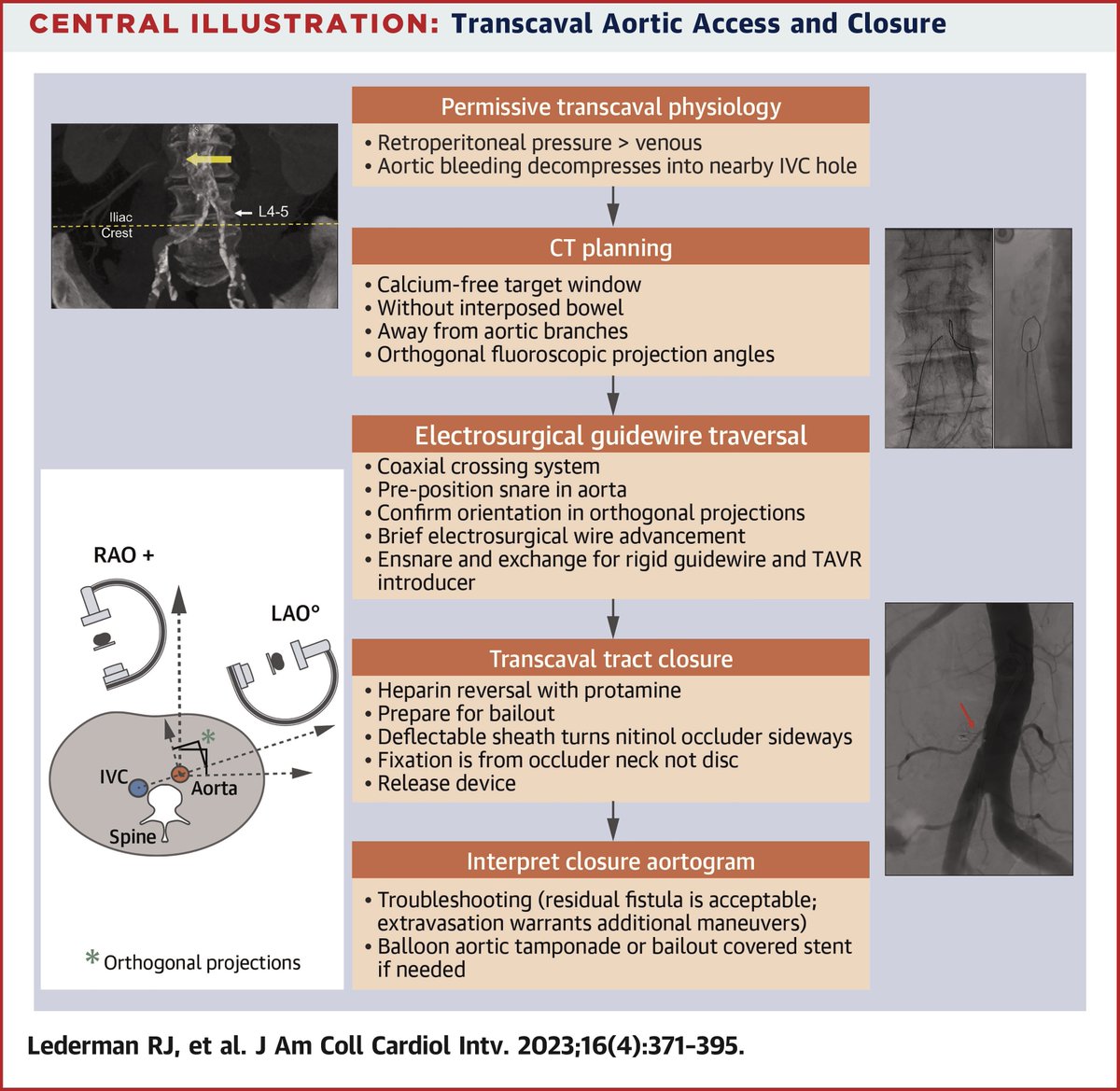 JACCJournals's tweet image. Looking for alternative vascular access options for #TAVR? Why not #transcaval access!

Check out this state-of-the-art review, just published in #JACCINT, describing preparation, crossing and closure steps in detail: bit.ly/3kE0saC

#CardioTwitter @AdamGreenbaumMD