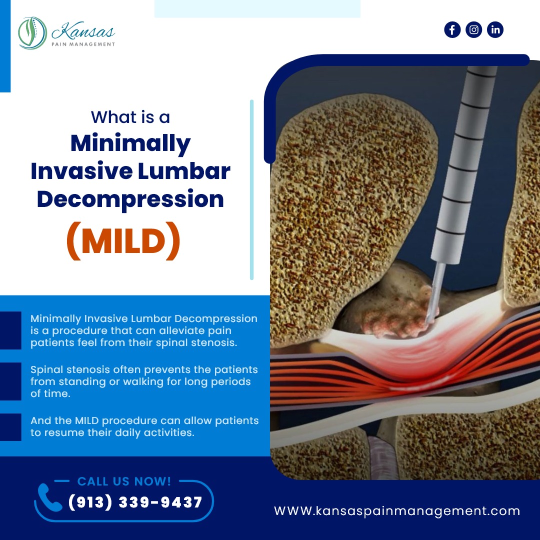 KansasPain's tweet photo. #MinimallyInvasiveLumbarDecompression is a procedure that can alleviate pain patient feel from their spinal stenosis. #Spinalstenosis often prevent the patients from standing or walking for long periods of time, and the #MILDprocedure can allow patients to resume daily activities https://t.co/wz4TAmsvQA