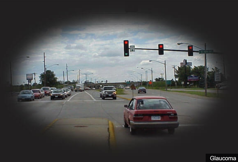 Jesusbaby 👼 on Twitter "RT USMLEStepStudy Vision common defects