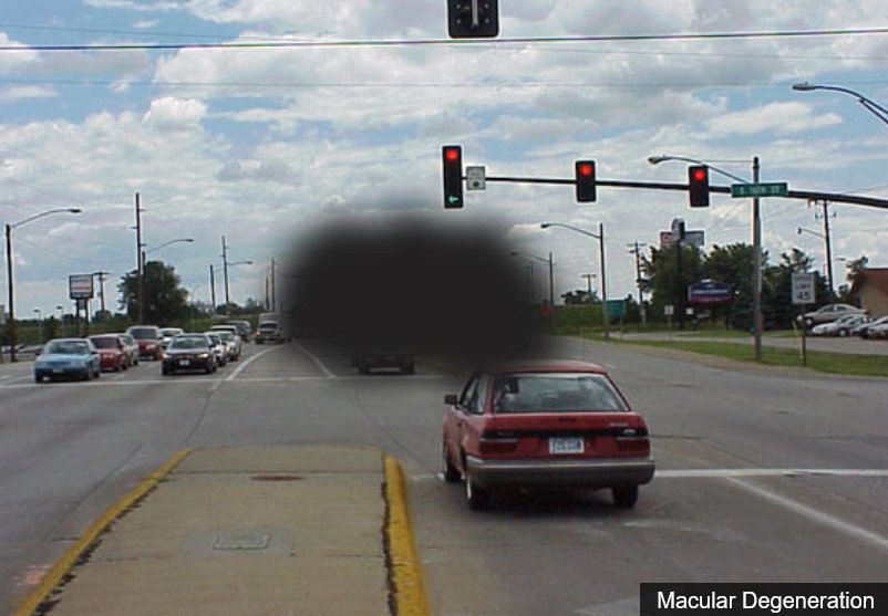 Jesusbaby 👼 on Twitter "RT USMLEStepStudy Vision common defects