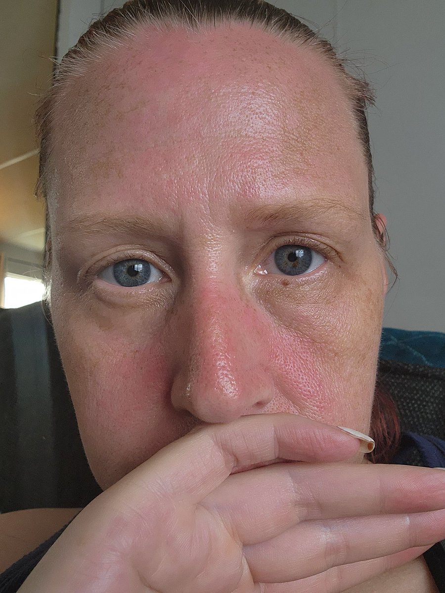 01SaltyBeach's tweet image. As I sat to go through some things, I happened to notice my skin felt tight. I opened my phone to find out that during the time frame I was outside (about 2 hours), I got sunburnt. Ugh. One of the drawbacks of being fair skinned. #RedHeadProblems Ugh.