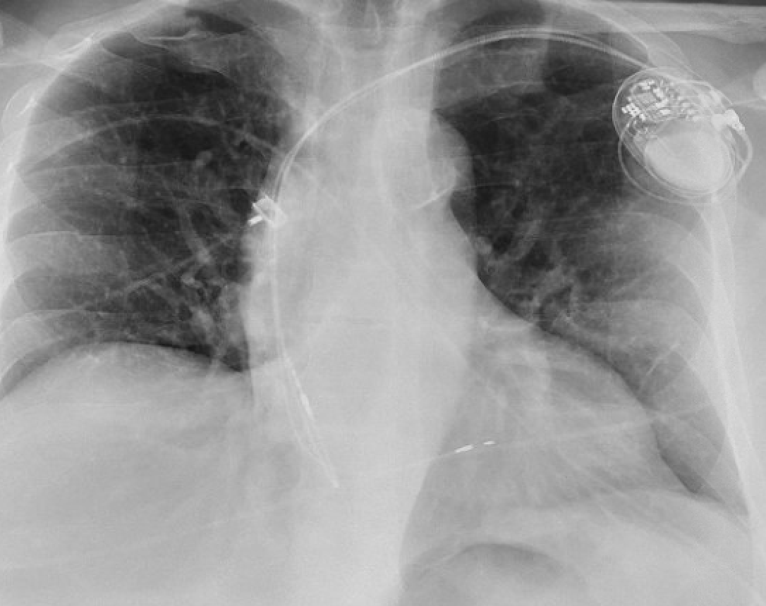 Toaster_Pastry's tweet photo. Just when you thought pacemakers are outdated technology, someone decided that we should no longer place right ventricular leads at the apex of the right ventricle. #leftbundlebranchpacing https://t.co/5MpfhGueLj