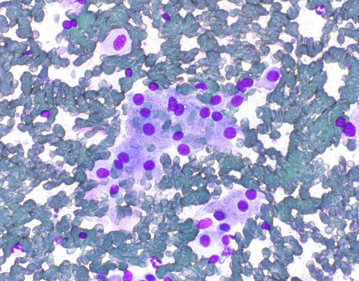 IHC_guy's tweet photo. FNA of a gallbladder mass. Diagnosis?

This one has #PathTwitter written all over it.

@HubertLauMD is going to make the diagnosis in the blink of an eye . . . this one took me a couple beats. https://t.co/IhI6XQ04O1