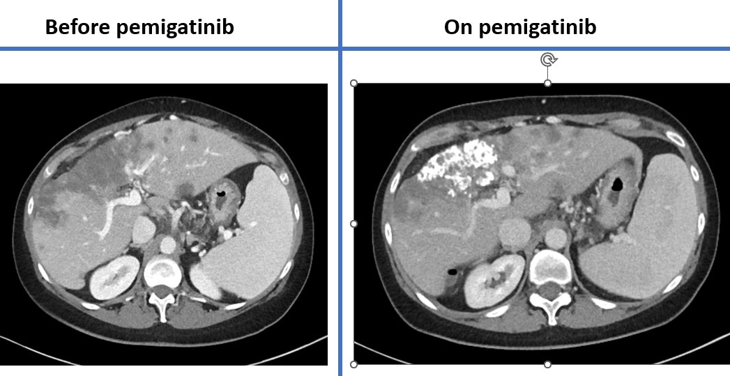 What drug is this patient on...?

A patient with intrahepatic cholangiocarcinoma with FGFR2 fusion. Responding nicely to pemigatinib, an FDA-approved FGFR inhibitor. Tumor calcifications are sometimes seen and here is an example of that. Remember, sequence ALL biliary cancers!!!