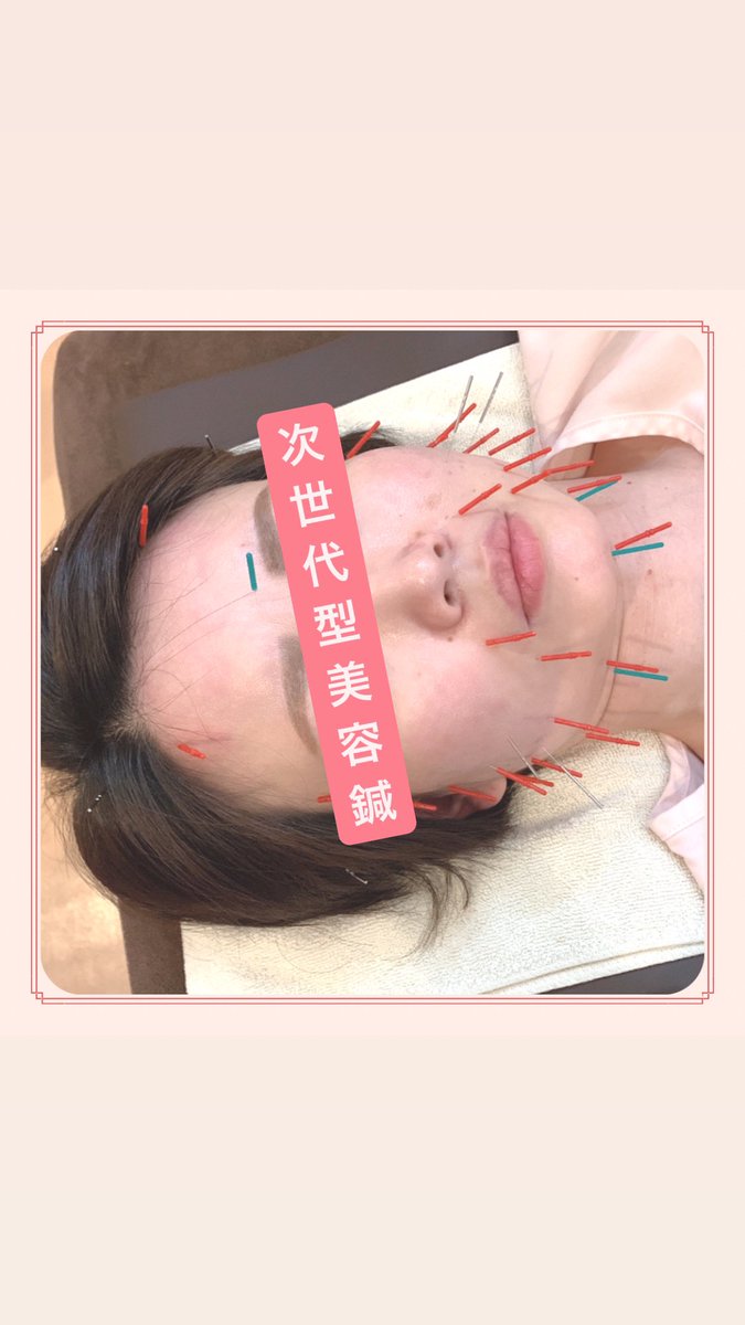 yotsuba_aoc's tweet photo. ⁡
🍀30代  たるみ、ほうれい線、小じわ🍀
ご家族の紹介で初めての美容鍼✨
同時に体も疲れていたので全体治療もして頂きました👍🏻
皆さん❗️
脱マスクに向けて始めてる方が増えていますよ😷‼️
マスクを外した時に
｢あれ😮 意外と年齢より老けて見える…｣
なんて思われたくないですよね💦
⁡
⁡ https://t.co/Pg0ZDUnBvp