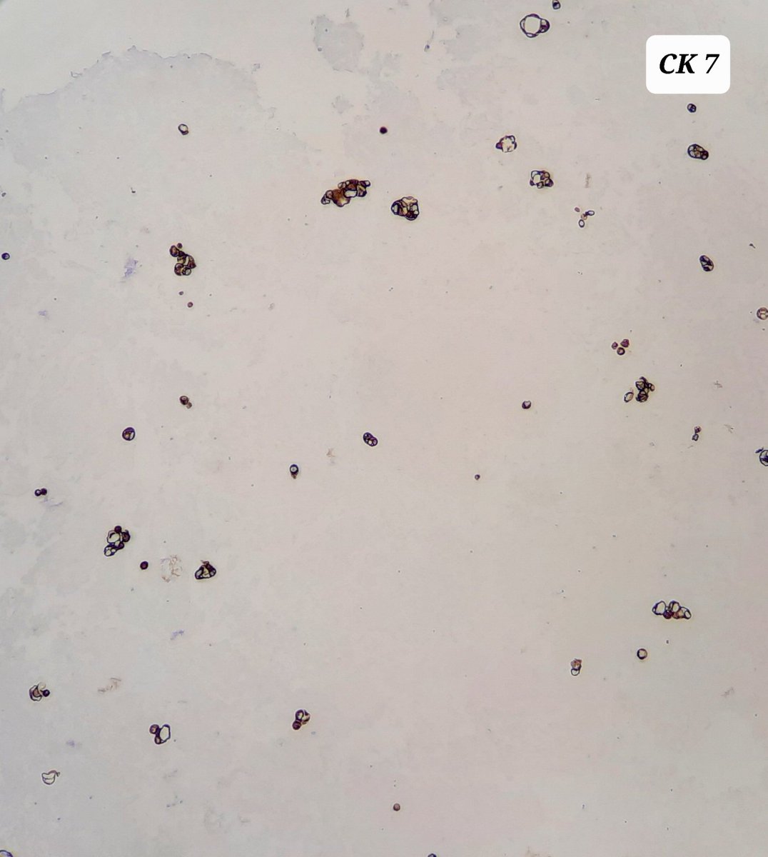amnabruno's tweet image. ▶️Ascitic Fluid, 64 years male. 
🔅CK 7, EMA: Positive 
🔸️Desmin:  Negative 
📌 Diagnosis? Category? 
#TwitterPath #Cytology #MedTwitter #Ascites #SurgicalPathology