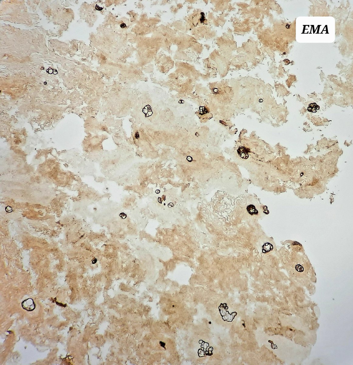 amnabruno's tweet image. ▶️Ascitic Fluid, 64 years male. 
🔅CK 7, EMA: Positive 
🔸️Desmin:  Negative 
📌 Diagnosis? Category? 
#TwitterPath #Cytology #MedTwitter #Ascites #SurgicalPathology
