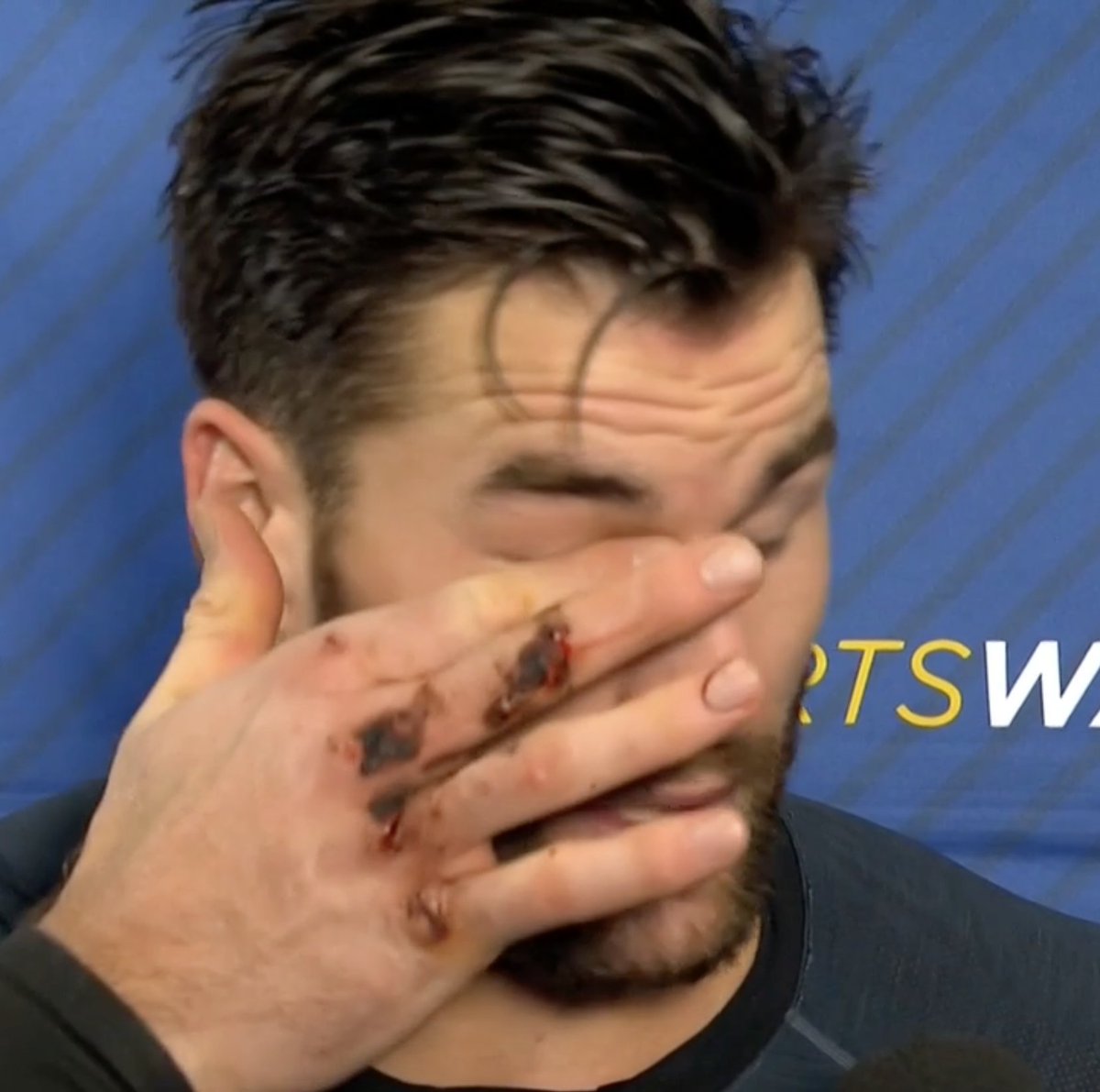 sammisilber's tweet photo. A glimpse at Tom Wilson's hand postgame. Hurt it after catching Nathan Beaulieu in the helmet during their third-period fight.

Wilson went off for repairs and came back before scoring the OT winner for the Capitals. Finished with two goals and a team-leading seven shots. https://t.co/NwrqH7hZ0e