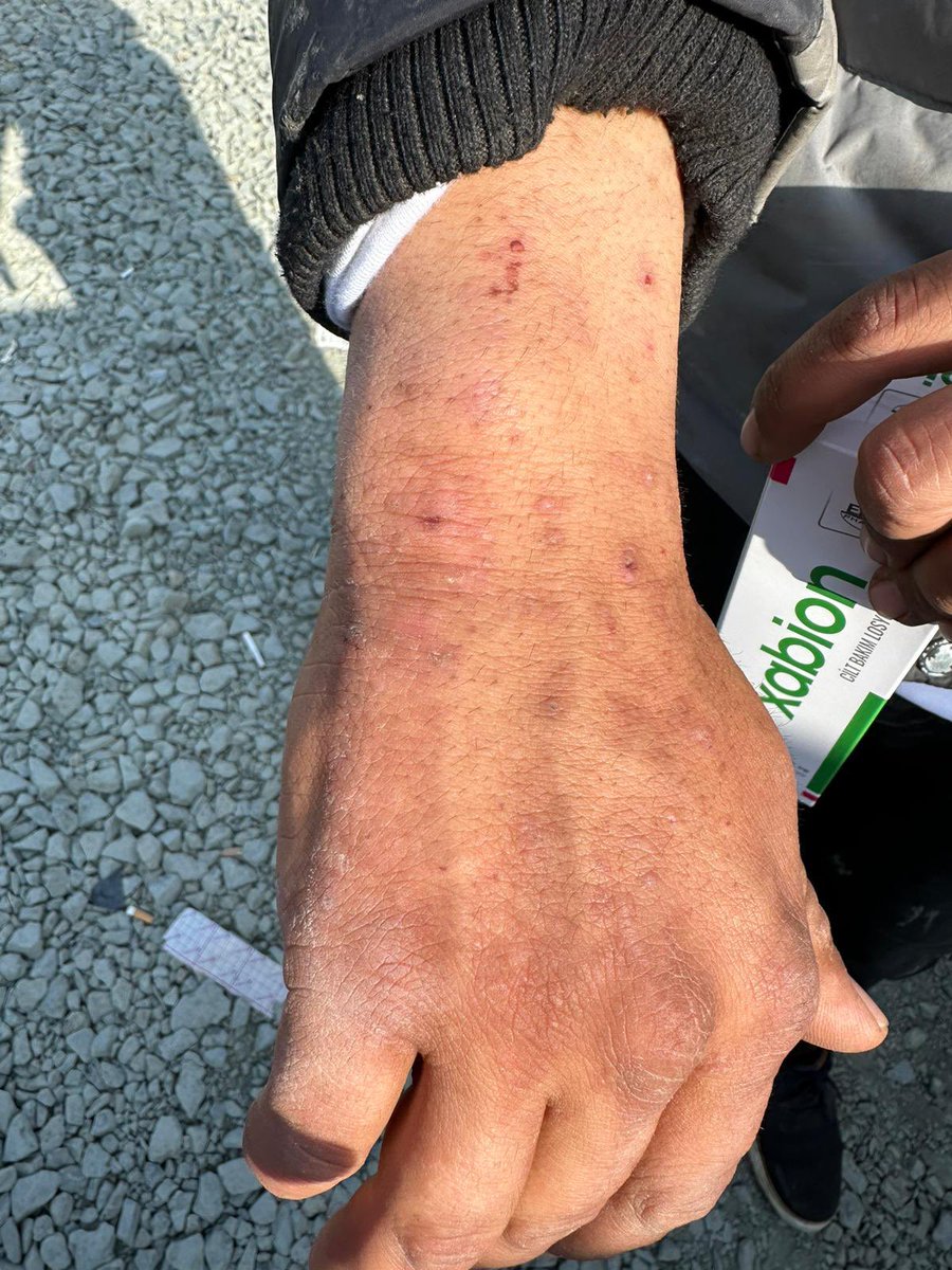 turyildizbicer's tweet photo. Hatay’da sahra hastanesindeyim, durum bu!
Uyuz vakalarında artış görüyoruz.

AKP, inşaat peşinde koşadursun; henüz çadırı olmayan depremzedeler kendi yaptıkları derme çatma yerlerde barınıyor.
Hijyensiz, sağlıksız, kalabalık ortamlarda uyuzun yayılması kolaylaşıyor doğal olarak. https://t.co/chyKTAU668