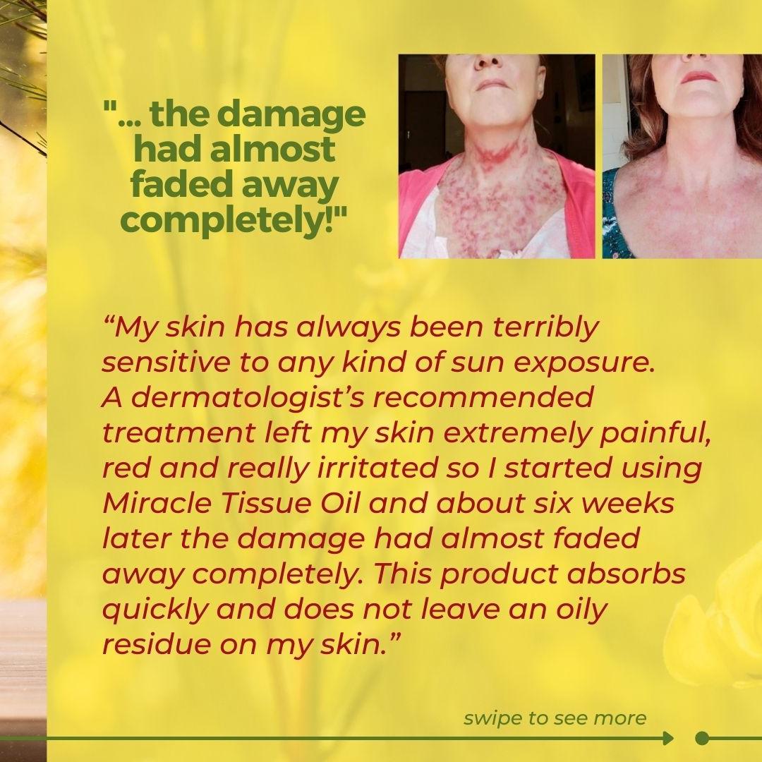 AnniqueHB's tweet photo. Are you tired of feeling self-conscious about your skin imperfections?😕  Look no further than 𝗠𝗶𝗿𝗮𝗰𝗹𝗲 𝗧𝗶𝘀𝘀𝘂𝗲 𝗢𝗶𝗹! ✨! Say goodbye to scars, wrinkles, uneven skin tone, and stretch marks😄 

#Annique #Rooibos #RooibosProducts #Testimonials #Thursday #Skincare https://t.co/BtAAeIJvOS