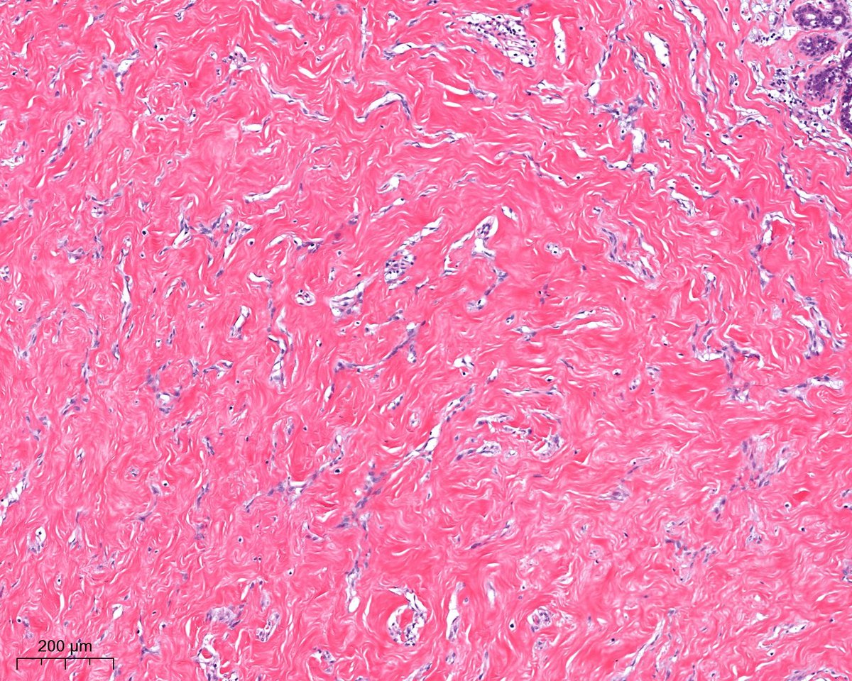 A. Polónia (@poloniaantonio) on Twitter photo benign nodule of the breast😃#breastpath <a href="/atman_ci/">Dr. Luca</a> <a href="/DrGeeONE/">Olaleke Folaranmi</a> <a href="/ADamronMD/">Alexander Damron, MD</a> <a href="/LizaMQuintana/">Liza Quintana, MD</a> <a href="/AGrabenstetter/">Anne Grabenstetter</a> <a href="/tlabiano/">Tania Labiano</a> <a href="/jennpincus/">Jenny Pincus, MD</a> <a href="/A_Morini_MD/">Aurélien Morini, MD, MSc 🇫🇷🇪🇺💙💛</a> <a href="/ariella8/">Celina Stayerman MD</a> <a href="/nusrat_xahra/">🔻Nusrat Zahra🔻🇵🇸</a> @miss_me1986 <a href="/gonzadetoro/">Gonzalo De Toro</a> <a href="/TristanRutland7/">Tristan Rutland MBBS FRCPA IFCAP</a> <a href="/SumantaDas_7/">Sumanta Das</a> <a href="/israhkhan/">Israh Akhtar Khan</a> <a href="/kis_lorand/">Lorand Kis</a> <a href="/nucleololailo/">Carlos Miguel Ruiz</a> <a href="/joaquinnieves55/">Carlos Nieves</a> benign nodule of the breast😃#breastpath <a href="/atman_ci/">Dr. Luca</a> <a href="/DrGeeONE/">Olaleke Folaranmi</a> <a href="/ADamronMD/">Alexander Damron, MD</a> <a href="/LizaMQuintana/">Liza Quintana, MD</a> <a href="/AGrabenstetter/">Anne Grabenstetter</a> <a href="/tlabiano/">Tania Labiano</a> <a href="/jennpincus/">Jenny Pincus, MD</a> <a href="/A_Morini_MD/">Aurélien Morini, MD, MSc 🇫🇷🇪🇺💙💛</a> <a href="/ariella8/">Celina Stayerman MD</a> <a href="/nusrat_xahra/">🔻Nusrat Zahra🔻🇵🇸</a> @miss_me1986 <a href="/gonzadetoro/">Gonzalo De Toro</a> <a href="/TristanRutland7/">Tristan Rutland MBBS FRCPA IFCAP</a> <a href="/SumantaDas_7/">Sumanta Das</a> <a href="/israhkhan/">Israh Akhtar Khan</a> <a href="/kis_lorand/">Lorand Kis</a> <a href="/nucleololailo/">Carlos Miguel Ruiz</a> <a href="/joaquinnieves55/">Carlos Nieves</a>