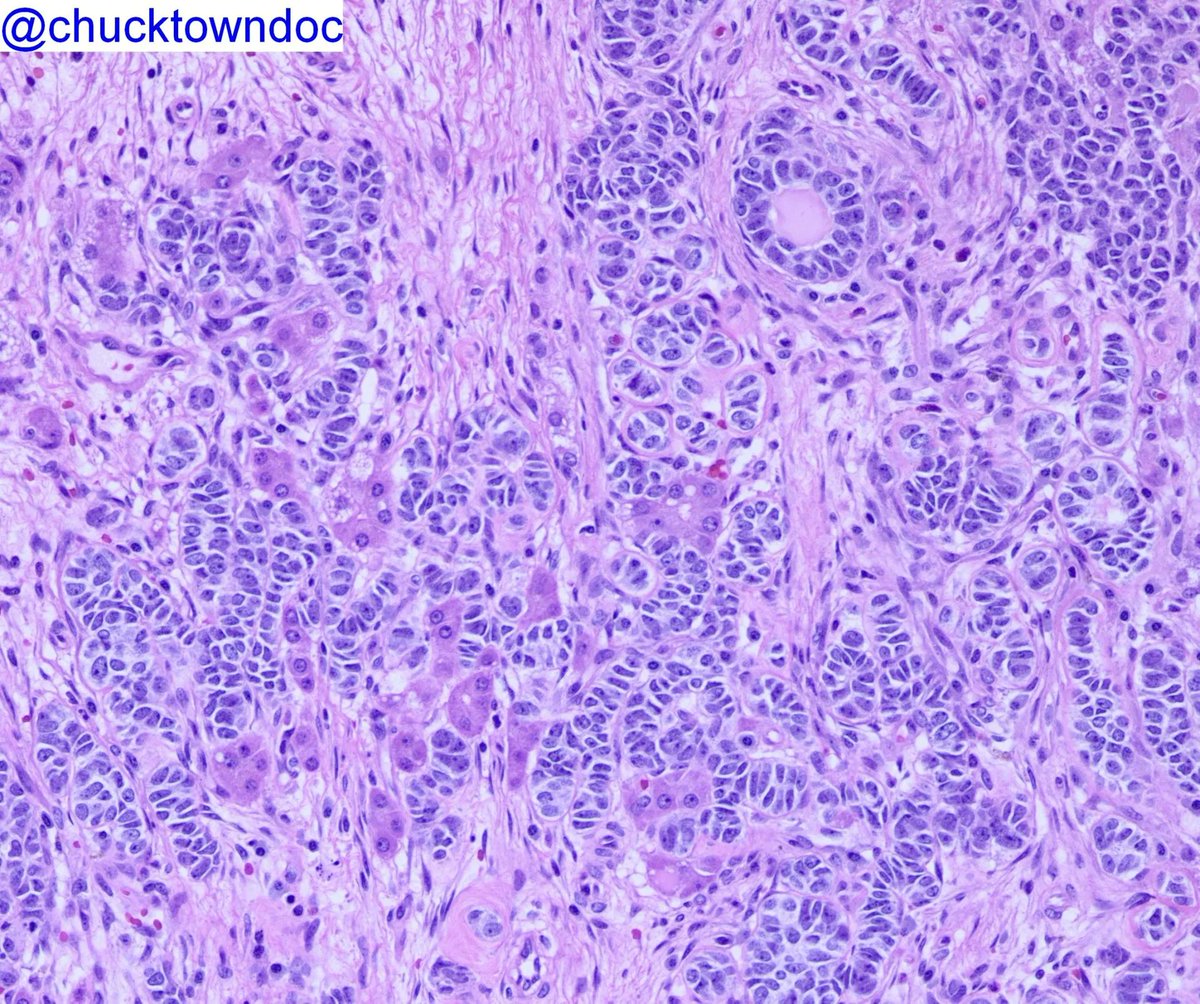 Virilization workup reveals ovarian mass.
Case by Dr. Frank Ingram <a href="/Chucktowndoc/">Frank Ingram, MD</a>.
Diagnosis? Possible mutations?
More pics &amp; Answers: kikoxp.com/posts/17915
More cases from Dr. Ingram on his Kiko profile: kikoxp.com/frank_ingram3
#GYNpath #pathology #pathTwitter #OBGYNTwitter