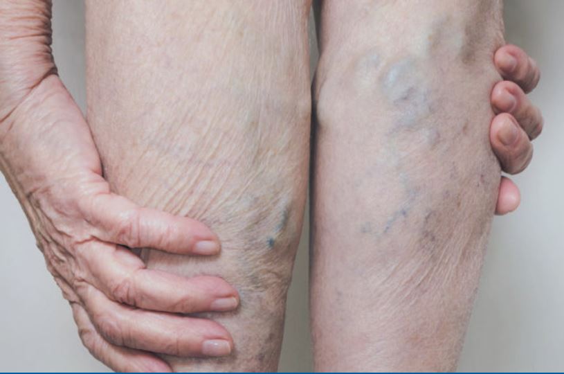 AhsanAl15313163's tweet image. Poor Blood Circulation - Symptoms , Causes and Treatment

#bloodcirculation #poorbloodcirculation #veinshealth #vascular #vascularcare #health #healthcare #lifestyle #texas 

americanveinclinics.com/blog/is-poor-c…