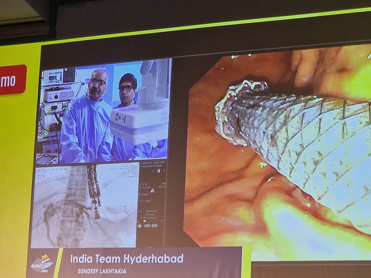 SyedGerdezi's tweet photo. The magician of #EUS world @DrLakhtakia showing his masterly skills of EUS-HGS at #EuroEus2023
(PS. 15 min for the whole procedure)
#NextGenEus
#Milan https://t.co/KHH6MtKgtf