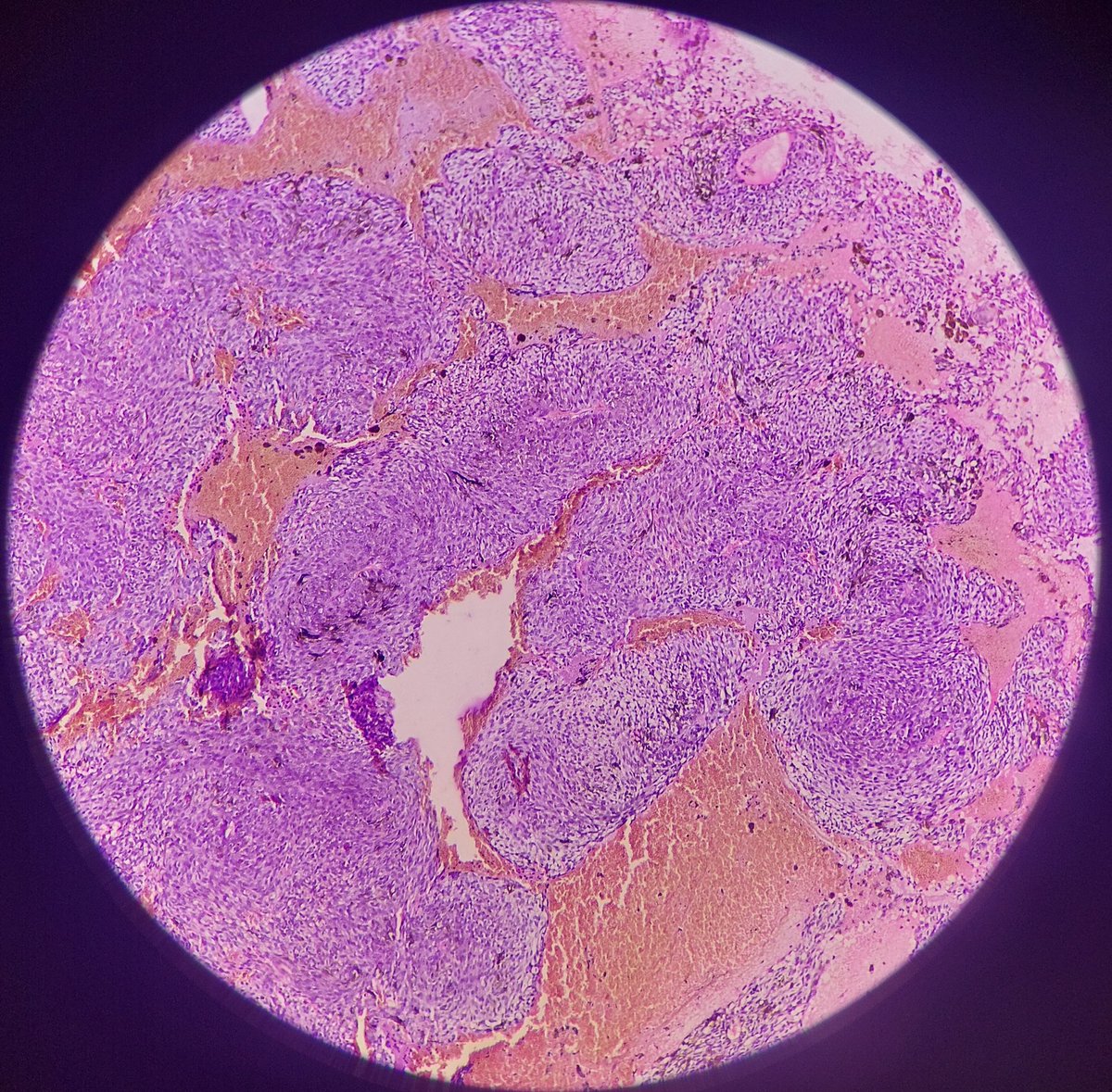 ViralBhanvadia's tweet image. 65/f, proptosis,conjunctival chemosis, orbital mass, MRI- well demarcated,intraconal mass,post.inf.lateral aspect,adherent to optic nerve sheath complex,3.5x2.2x3.1cm.#cnspath,#eyeyepath,#neuropath,@eyepathlondon @CraigHorbinski @NeuroEyepath @aanchalkakkar