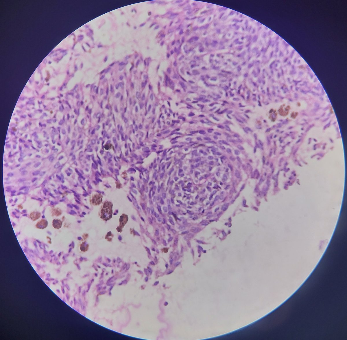 ViralBhanvadia's tweet image. 65/f, proptosis,conjunctival chemosis, orbital mass, MRI- well demarcated,intraconal mass,post.inf.lateral aspect,adherent to optic nerve sheath complex,3.5x2.2x3.1cm.#cnspath,#eyeyepath,#neuropath,@eyepathlondon @CraigHorbinski @NeuroEyepath @aanchalkakkar