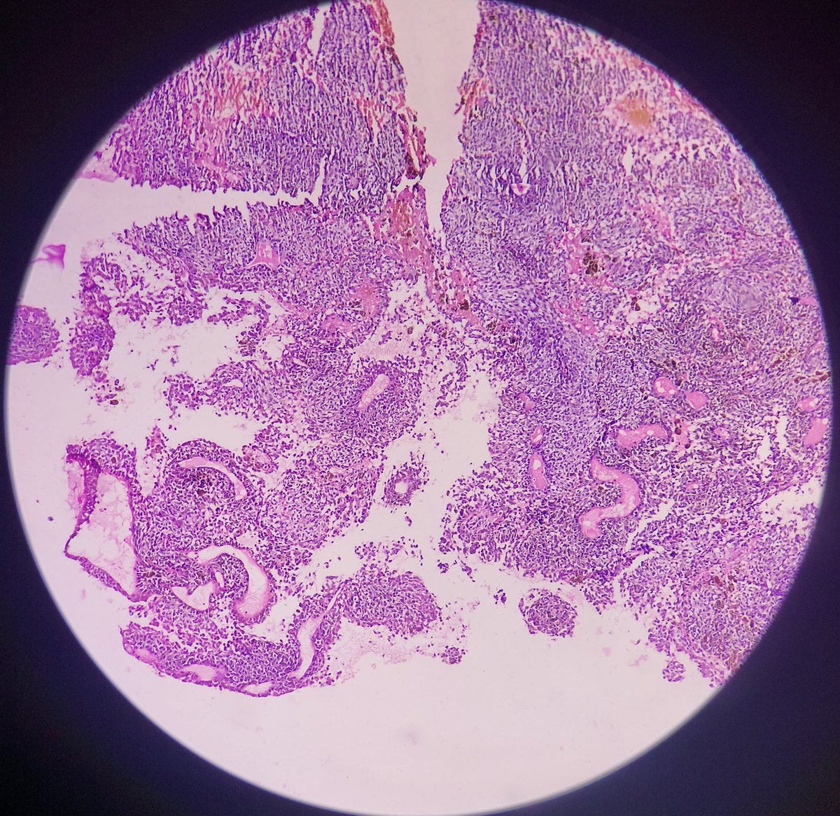 ViralBhanvadia's tweet image. 65/f, proptosis,conjunctival chemosis, orbital mass, MRI- well demarcated,intraconal mass,post.inf.lateral aspect,adherent to optic nerve sheath complex,3.5x2.2x3.1cm.#cnspath,#eyeyepath,#neuropath,@eyepathlondon @CraigHorbinski @NeuroEyepath @aanchalkakkar