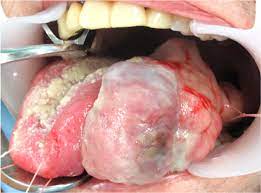 emergencyres's tweet photo. Spindle cell, a type of tumor that contains cells called spindle cells, based on their shape. Under a microscope, spindle cells look long and slender. Spindle cell tumors may be sarcomas or carcinomas.
#spindlecell #tumor #sarcoma #canncer #internalmedicine https://t.co/mKiS4DARj2
