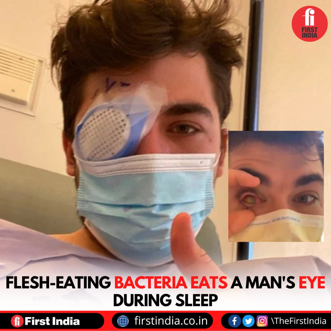 First India on Twitter "Flesheating bacteria eats a man's eye during