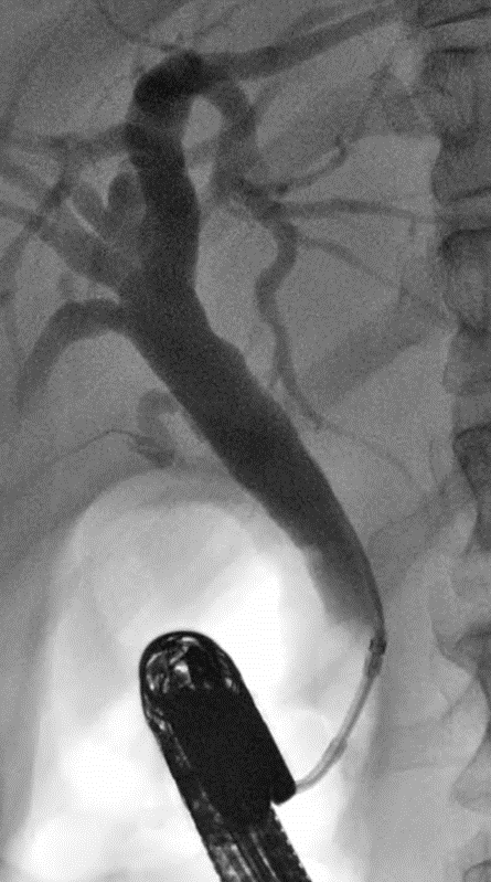 There once was a bile duct, beautifully stacked With tiny little stones, all cozy and packed In came a balloon, puffed up, tugged down Plop! Plop! Plop! Shimmering stones all around... #GITwitter #endoscopy #ERCP