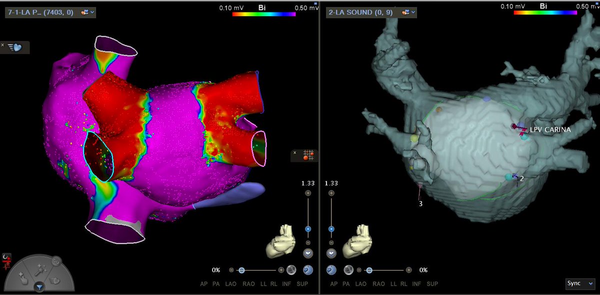 Madison Tracey (@madisontracey1) on Twitter photo Situs Inversus + Dextrocardia PVI and CTI! #Octaray #CARTOSOUND Very cool case! <a href="/Davilandre/">Andre dāAvila</a> <a href="/ZimetbaumP/">Peter Zimetbaum, MD</a> Situs Inversus + Dextrocardia PVI and CTI! #Octaray #CARTOSOUND Very cool case! <a href="/Davilandre/">Andre dāAvila</a> <a href="/ZimetbaumP/">Peter Zimetbaum, MD</a>