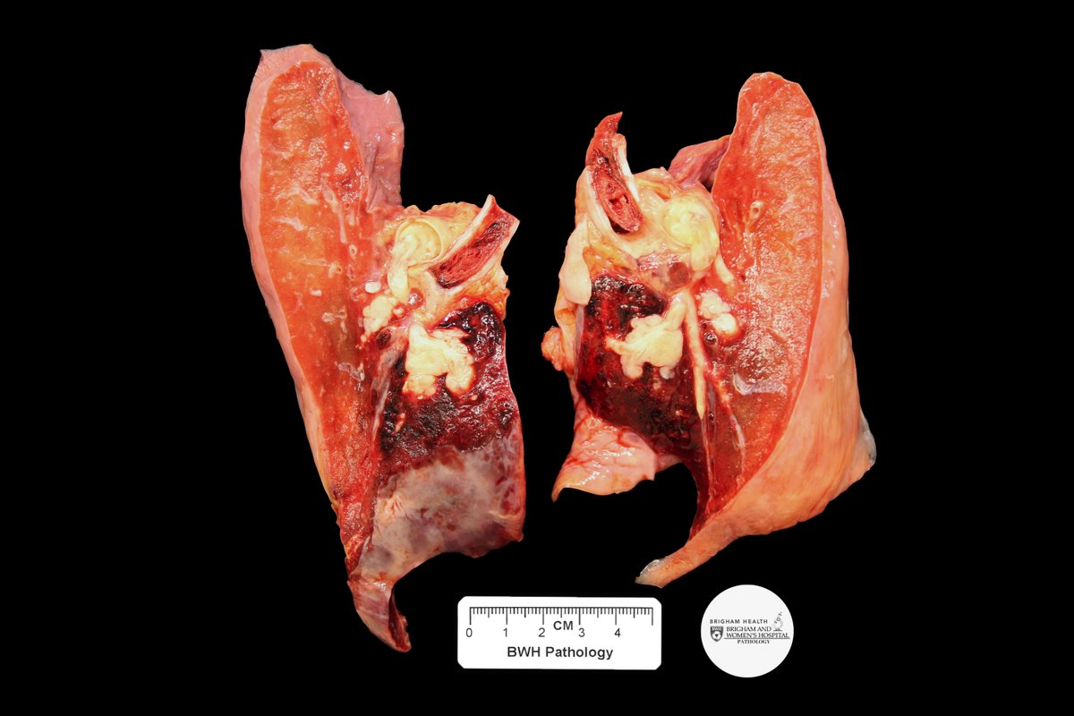 Welcome to the Gross Case of the Week! This week we have an autopsy case with interesting findings. #BWHgrossCOTW