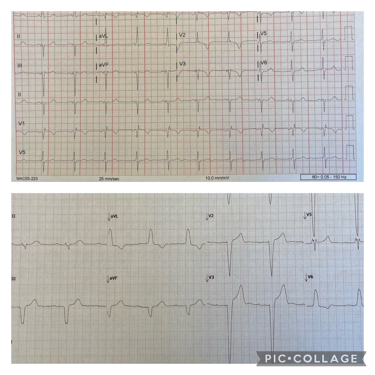 Left bundle area pacing (top) vs. native LBBB QRS (bottom) #EPeeps #CardioTwitter #epCRT #cvEP