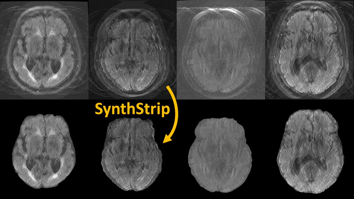 Malte Hoffmann (@mh3936) on Twitter photo Surprise! SynthStrip can often skullstrip MRI with motion artifacts, despite not seeing this at training. Tool at w3id.org/synthstrip <a href="/FreeSurferMRI/">FreeSurfer</a> <a href="/AdrianDalca/">Adrian Dalca</a> <a href="/mit_caml/">MIT Clinical and Applied Machine Learning</a> <a href="/MIT_CSAIL/">MIT CSAIL</a> <a href="/MGHMartinos/">MGH Martinos Center</a> Surprise! SynthStrip can often skullstrip MRI with motion artifacts, despite not seeing this at training. Tool at w3id.org/synthstrip <a href="/FreeSurferMRI/">FreeSurfer</a> <a href="/AdrianDalca/">Adrian Dalca</a> <a href="/mit_caml/">MIT Clinical and Applied Machine Learning</a> <a href="/MIT_CSAIL/">MIT CSAIL</a> <a href="/MGHMartinos/">MGH Martinos Center</a>