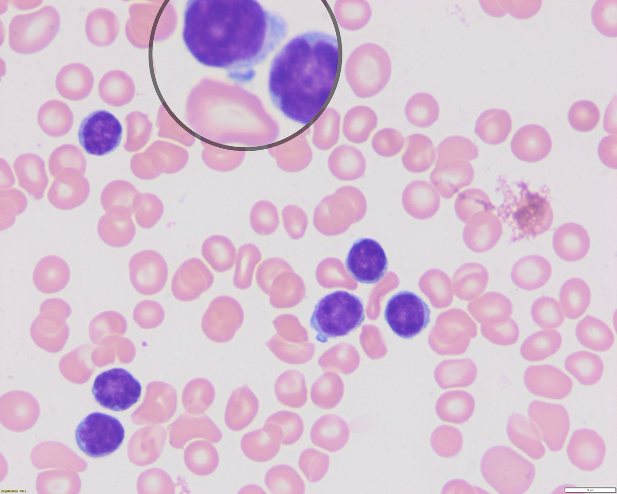sanamloghavi's tweet photo. Kudos to camp TCL1 FISH. high WBC + morphology (cytoplasmic Blebs): think T-prolymphocytic leukemia, defined by TCL1 rearrangement (inv 14q). Coincidentally 🔥 off the press in @Nature on the significance of Blebs https://t.co/sGCLDdLNIe by @MuthrNaturzSon and team  #hemepath https://t.co/VGWUbGFiRI