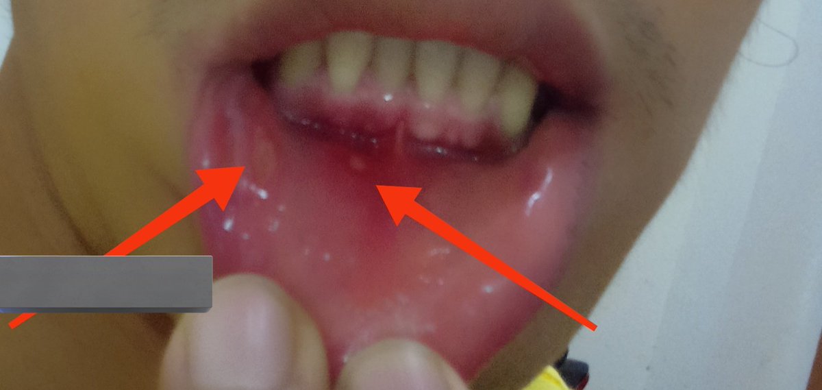 ဒီလို ဘုလေးပေါက်နေတာ
ဘာဆေးသောက်ရမလည်းဗျ
😧😥 ဘာဖြစ်တာလည်းဗျ 
ခဏခဏဖြစ်တာ