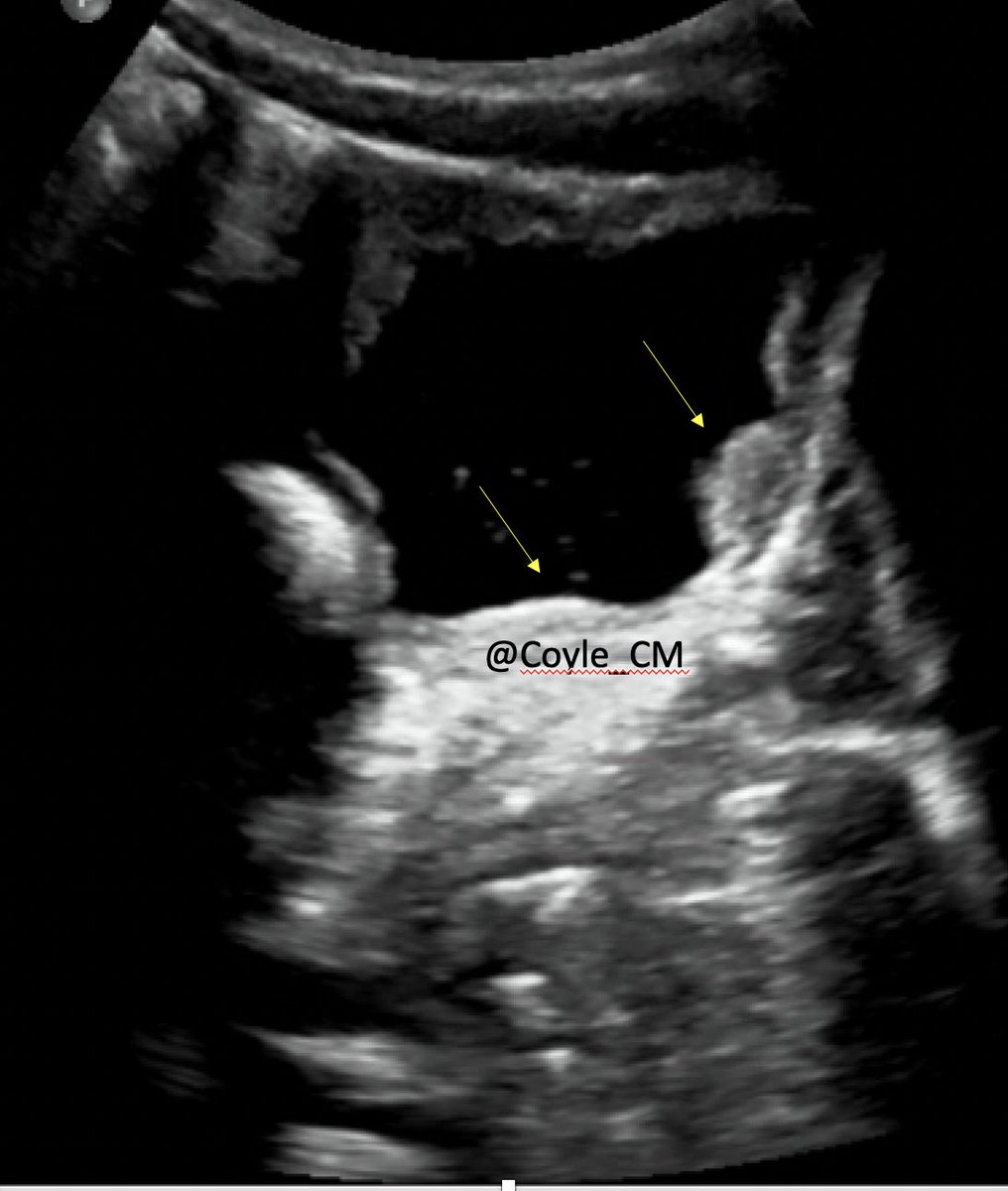 I am back for more discussion #Tropmed schisto case ..yes, @tmhohl71 and others are right! Give praziquantel and get an US. Bladder US with focal nodular thickening. Ureters are ok. I will be sending you a quiz on what do next. (1/2)