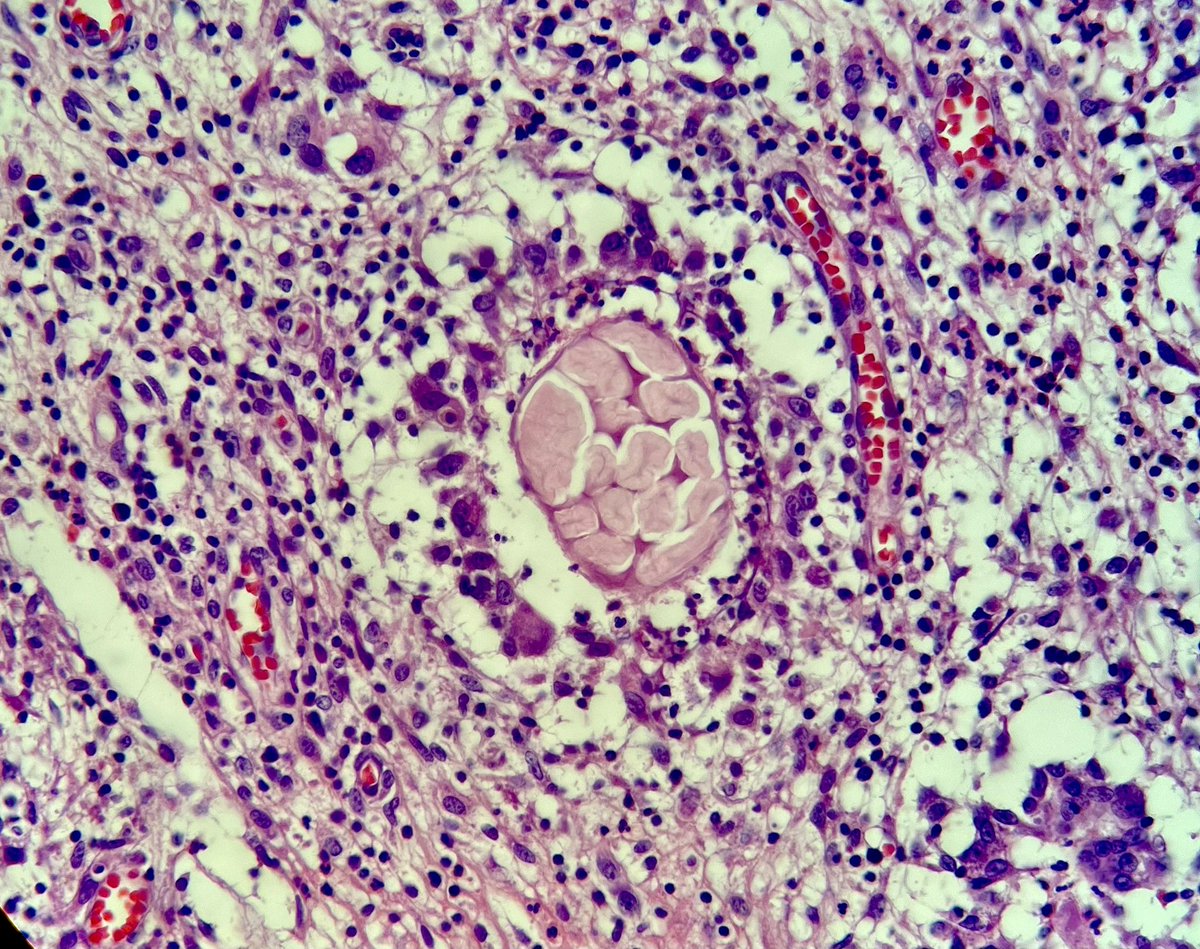 14 year old female patient with a fistula at neck region. Microscopy showed these eosinophilic material? #pathology #PathTwitter