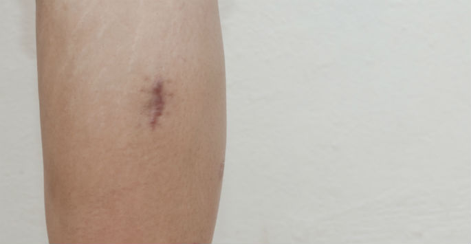 BeauTerreSkin's tweet photo. Minimize the appearance of your scars with a #PurSil treatment. https://t.co/HheL1deyEn https://t.co/TaUM1qcMrw