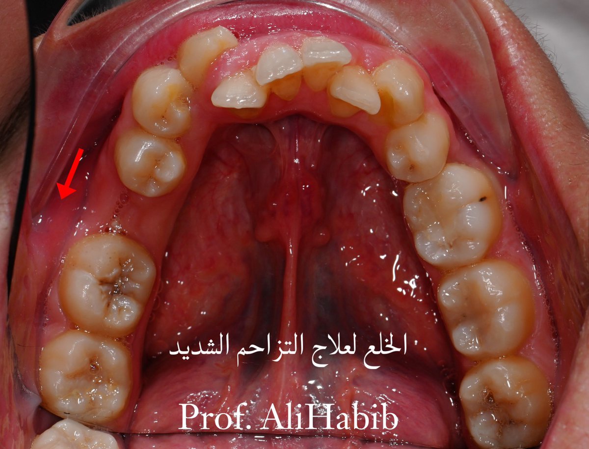 prof_alihabib's tweet photo. من اهم مشاكل الإطباق وأكثرها شيوعا مشكلة تزاحم الأسنان. العلاج يتم بطرق عدة: ١- توسيع الفك في الأبعاد الثلاثة (تزاحم متوسط أوبسيط).٢-برد الاسطح البينية للاسنان ( تزاحم متوسط او بسيط).٣- خلع اسنان (تزاحم شديد او مصاحب ببروز اسنان) ٤-بدون خلع باستخدام أكثر من طريقة. #تقويم https://t.co/vBPklQkuJt