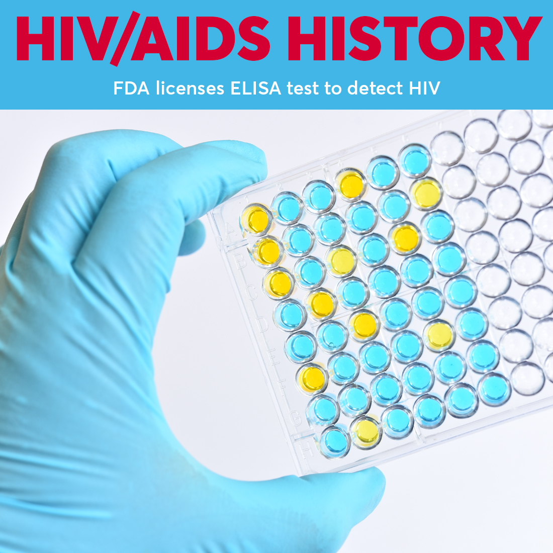 On March 2, 1985, the U.S Food and Drug Administration licensed the first commercial blood test, ELISA, to detect HIV. Blood banks began screening the U.S. blood supply.