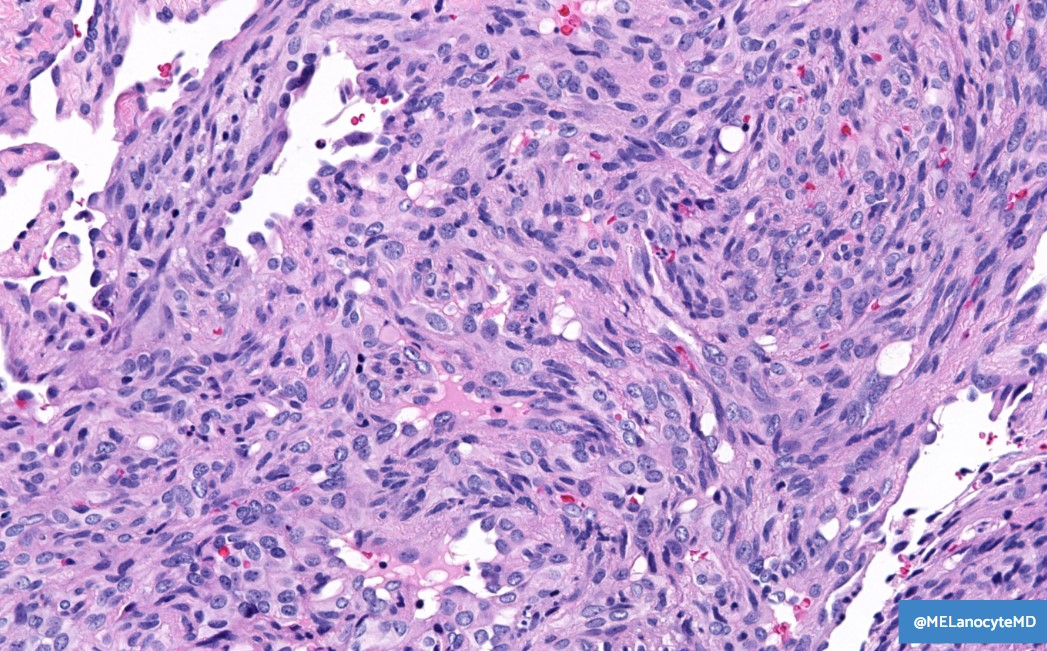 Spindle cell hemangioma:
👉 Young adults, distal extremities
👉 Dermal/SQ nodule(s)
🔬 Solid + vasoformative
🔬 ±Associated thrombosed BV
🔬 Spindle cells may have small vacuoles (lipoblast-like)
🧬 IDH1/2 mutations (germline = Maffucci syndrome)
#bstpath #dermpath #pathboards