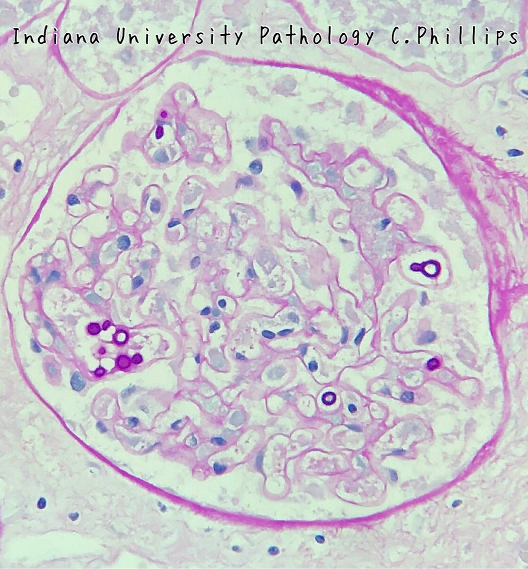 Autopsy kidney. Post-COVID. PAS stain of glomerulus. #renalpath
