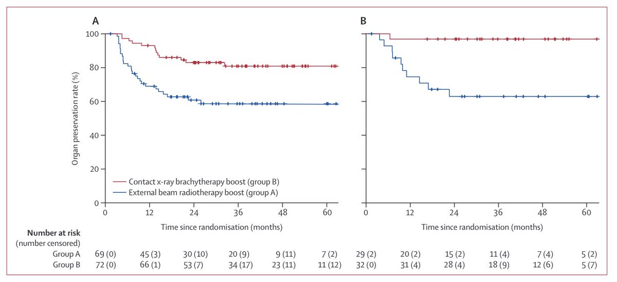 🚨OPERA Results are out
👉 148 rectal cancer patients rand to 45 Gy + 9 Gy or 45 Gy + 3 x 30 Gy (!!!) using Papillon
👉 Patients with early rectal tumors, Max cT3b
👉 An incredible organ preservation rate!
bit.ly/3J9Eohi
Congratulations to JP Gerard and Sun Mynt. #radonc