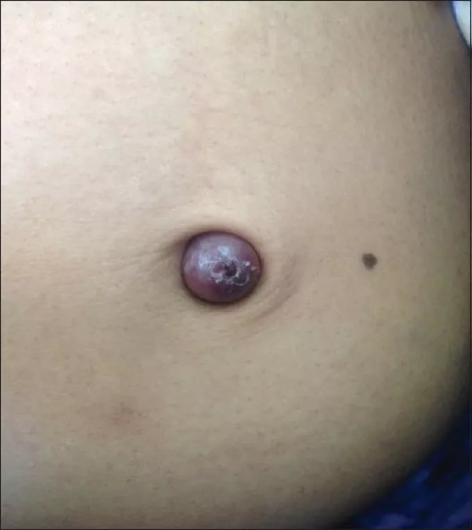 50 year old woman presents with abdominal pain and a lump in the belly button. What is the diagnosis?