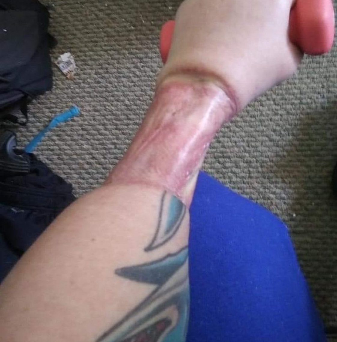 MAGACharlie2024's tweet photo. Paging Dr Mengele

This is a girl’s forearm. Her muscles have been farmed to create a fake phallus that doesn’t function. They will try to make her a fake urethra. She’ll probably be incontinent, she will certainly never function like a man. And her muscles won’t grow back https://t.co/uUVfZYLry6