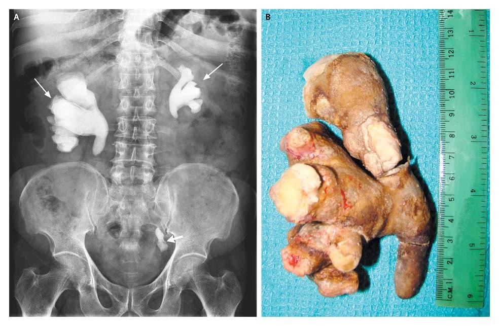 What's the name of this pathology?  (source: NEJM) #meded #urology #urotwitter #medtwitter #radtwitter #radiology