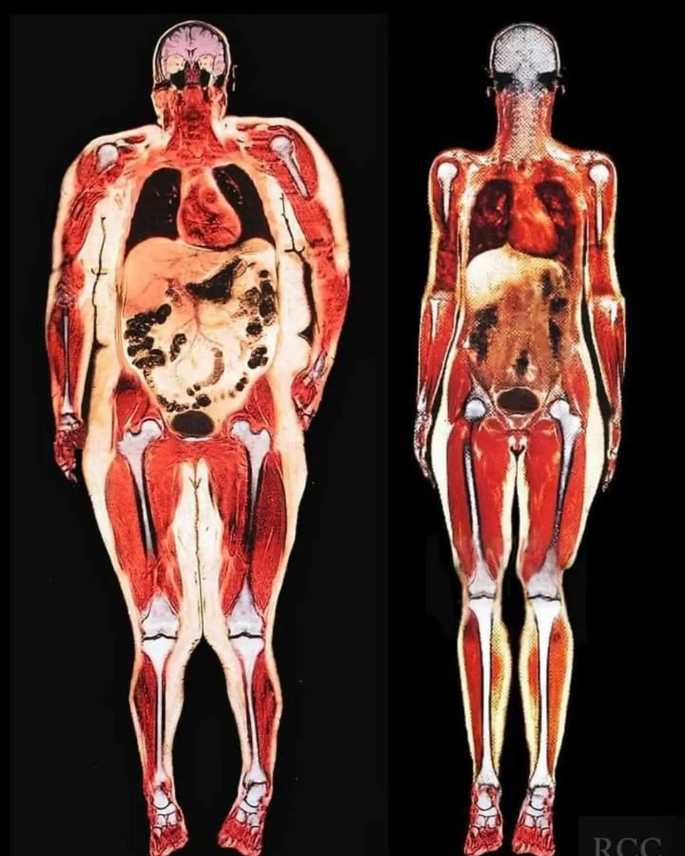 RincnCuriosoo's tweet photo. Escáner corporal de una chica con 113 kg y otra con 54 kg

El tamaño del corazón, intestinos y estómago son excesivos,los huesos prácticamente han modificado su posición y el líquido que hay entre el cráneo y el cerebro también es mayor. https://t.co/7m0Bwk1JAJ